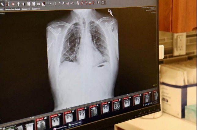 US Doctors Successfully Perform Double Lung Transplant On Cancer Patient