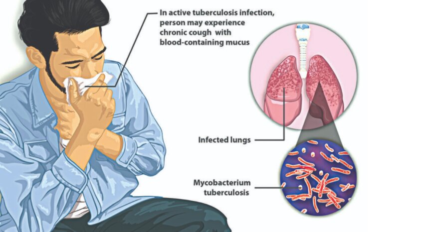 Tuberculosis