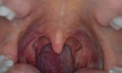 Throat cancer