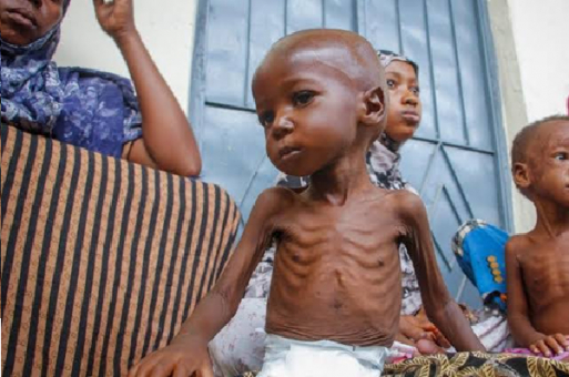 malnutrition surge in Bauchi 513x340 1