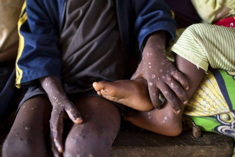Mpox Outbreak 768x512 1